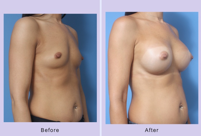 Before and After Image: breast augmentation – Case 34 - right-front-oblique