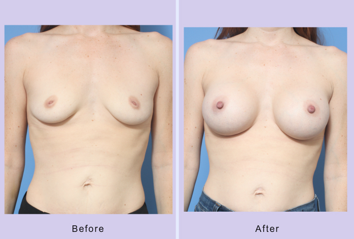 Before and After Image: Breast Augmentation – Case 35 - front