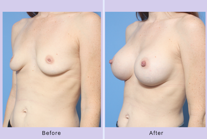 Before and After Image: Breast Augmentation – Case 35 - left-front-oblique