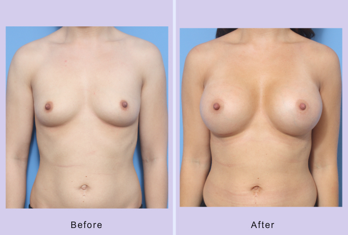 Before and After Image: Breast Augmentation – Case 36 - front