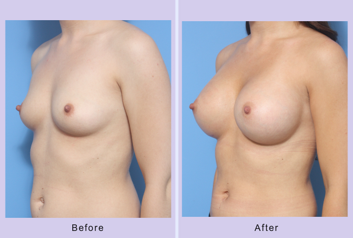 Before and After Image: Breast Augmentation – Case 36 - left-front-oblique