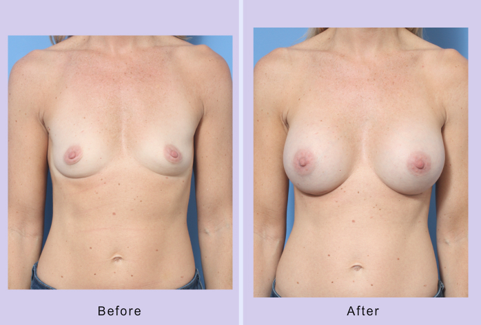 Before and After Image: Breast Augmentation – Case 37 - front