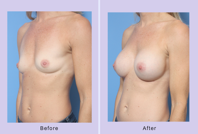 Before and After Image: Breast Augmentation – Case 37 - left-front-oblique
