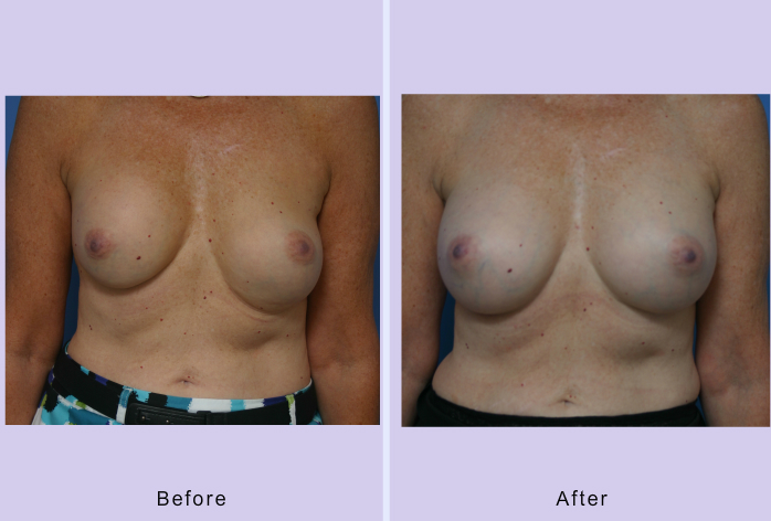 Before and After Image: Breast Correction – Case 13 - front