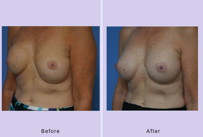 Before and After Image: Breast Correction – Case 13 - left-front-oblique