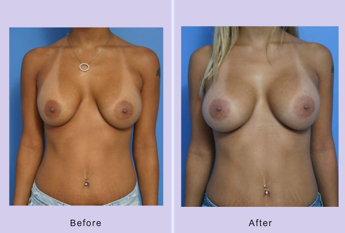 Before and After Image: breast correction – case 15 - front
