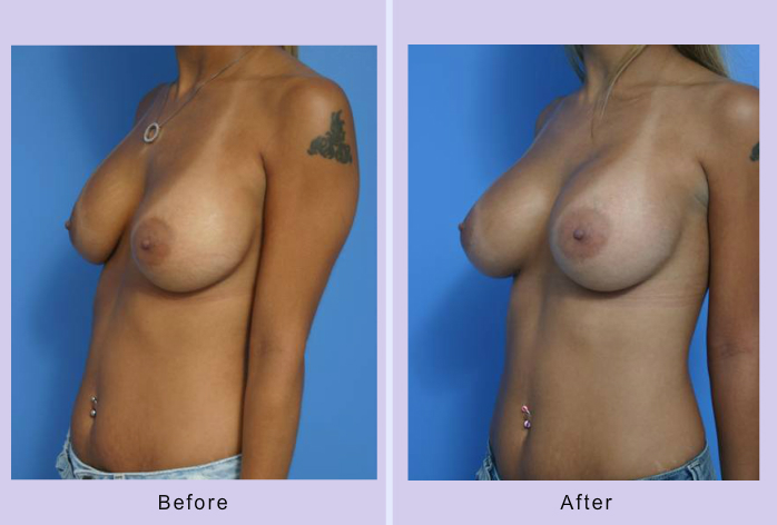 Before and After Image: breast correction – case 15 - left-front-oblique