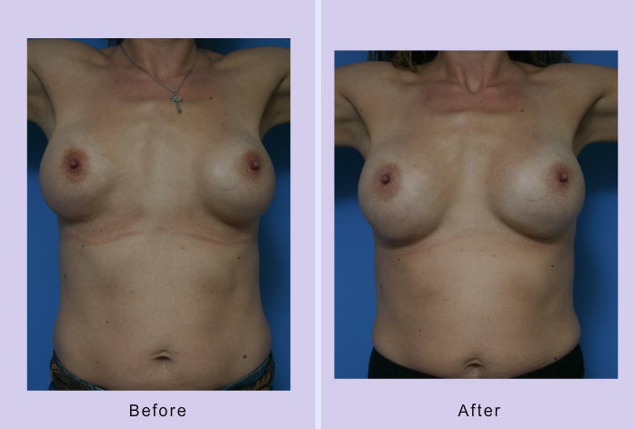 Before and After Image: breast correction – case 16 - front