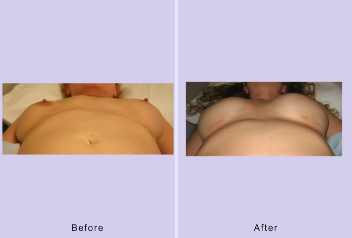 Before and After Image: breast correction – case 16 - front