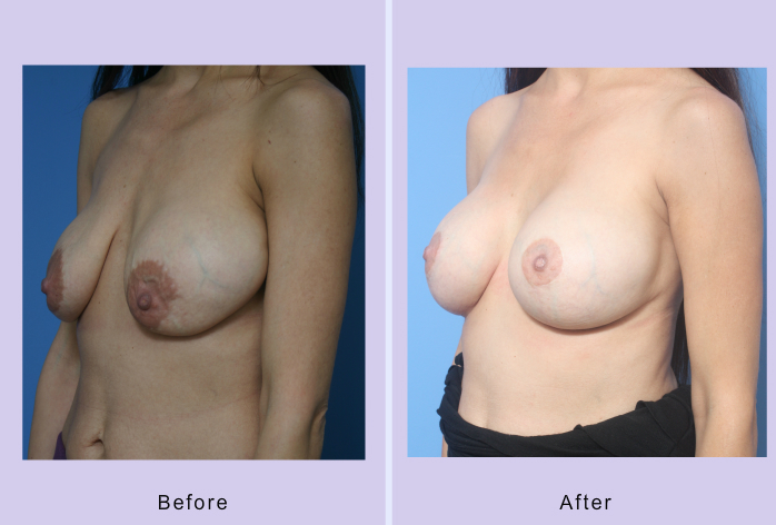 Before and After Image: breast correction – case 17 - left-front-oblique