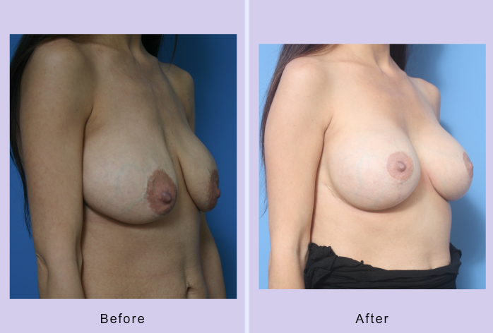 Before and After Image: breast correction – case 17 - right-front-oblique