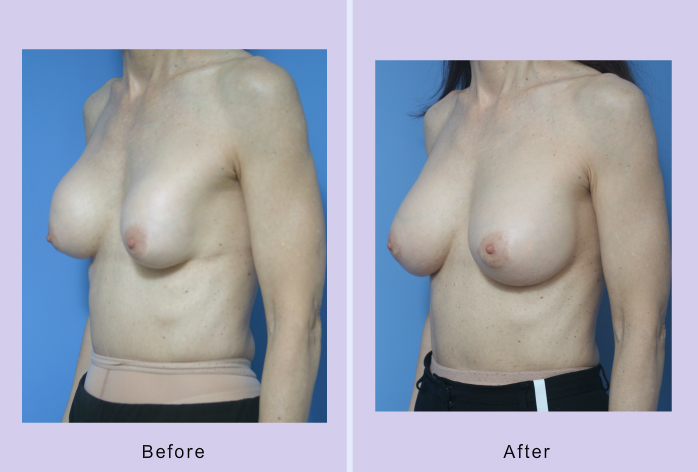 Before and After Image: breast correction – case 18 - left-front-oblique