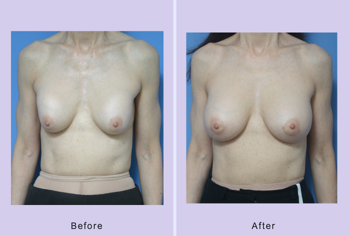 Before and After Image: breast correction – case 18 - front