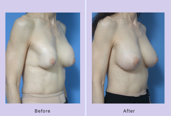 Before and After Image: breast correction – case 18 - right-front-oblique