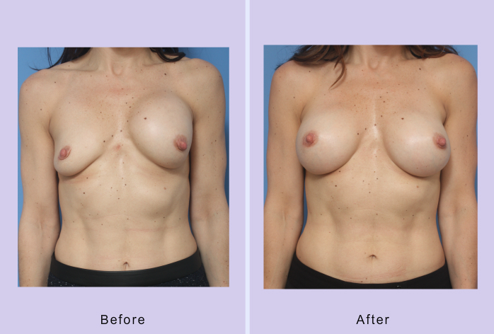 Before and After Image: breast correction – case 19 - front