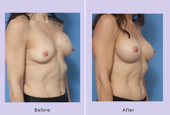 Before and After Image: breast correction – case 19 - right-front-oblique