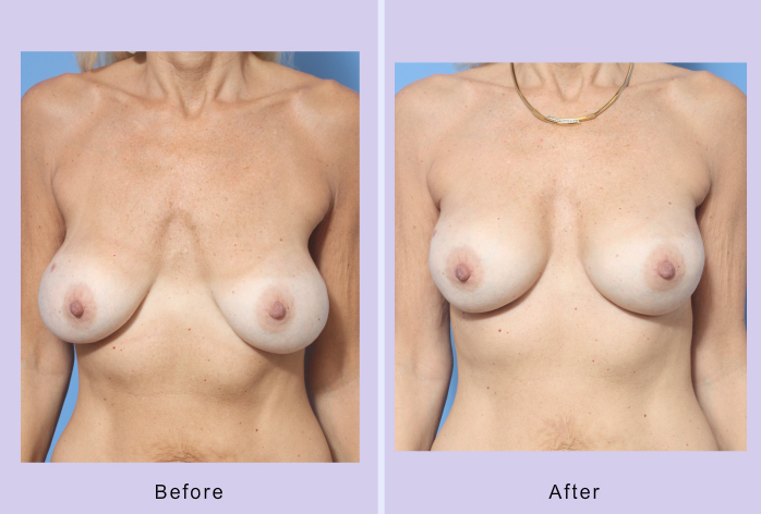 Before and After Image: Breast Correction – Case 20 - front