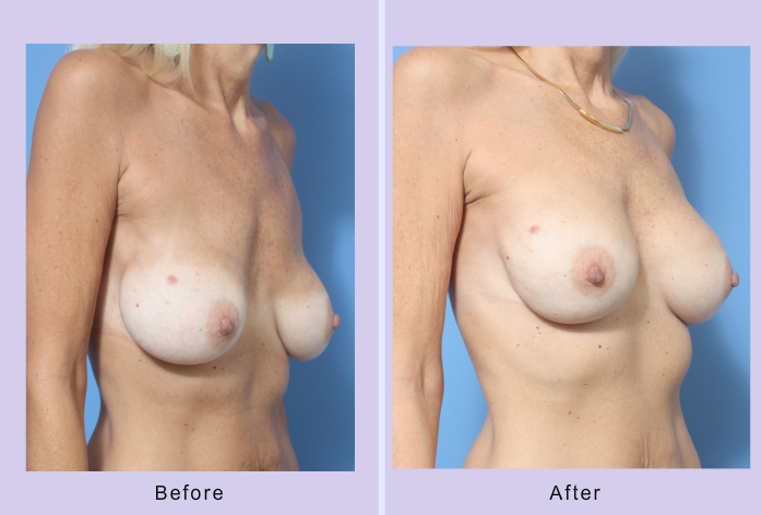 Before and After Image: Breast Correction – Case 20 - right-front-oblique