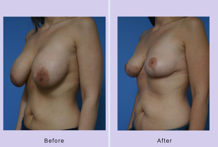 Before and After Image: Breast implant removal – Case 2 - other