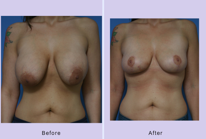 Before and After Image: Breast implant removal – Case 2 - front