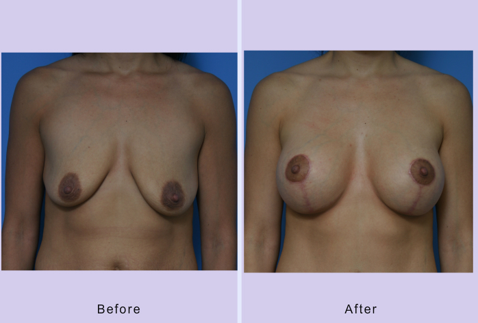 Before and After Image: Breast lift – case 11 - front