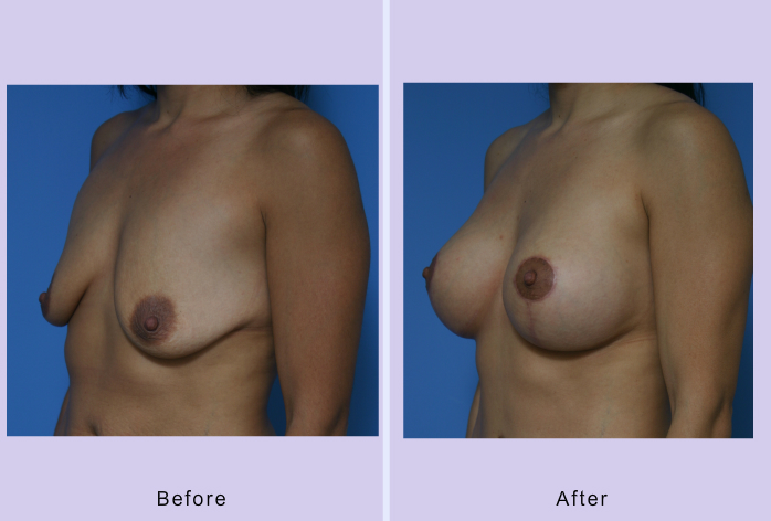 Before and After Image: Breast lift – case 11 - other