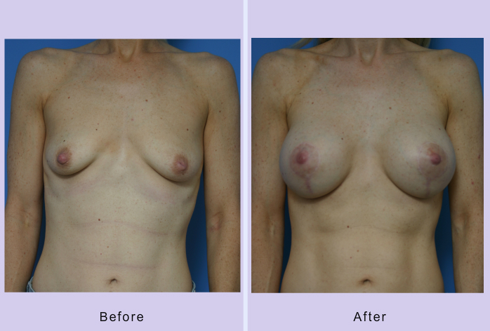 Before and After Image: Breast lift – case 12 - front