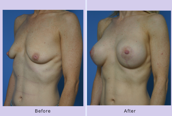 Before and After Image: Breast lift – case 12 - left-front-oblique