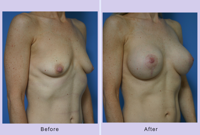 Before and After Image: Breast lift – case 12 - right-front-oblique