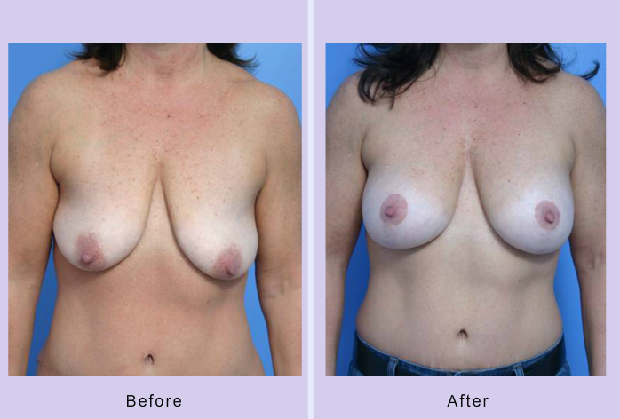 Before and After Image: breast lift – case 13 - front