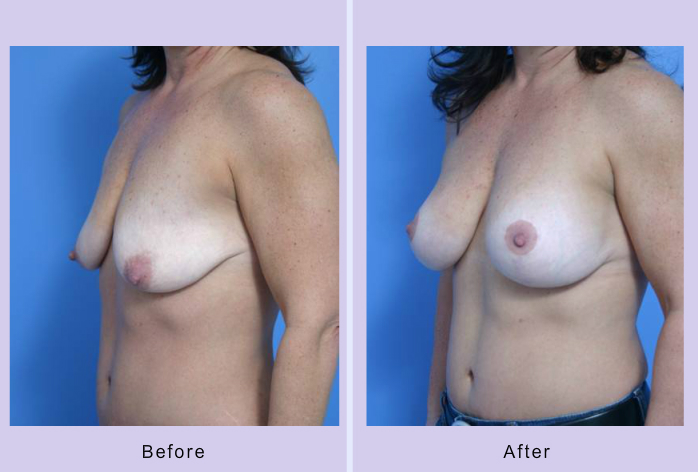 Before and After Image: breast lift – case 13 - other