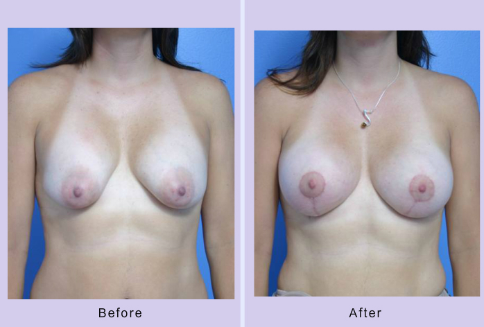 Before and After Image: breast lift – case 14 - front
