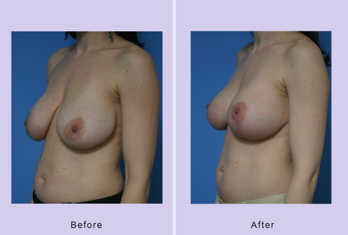Before and After Image: breast lift – case 15 - left-front-oblique