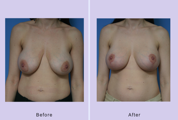 Before and After Image: breast lift – case 15 - front