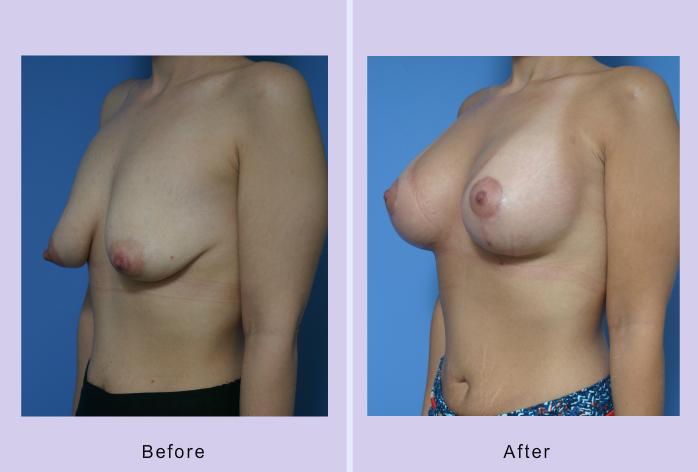 Before and After Image: breast lift – case 16 - left-front-oblique