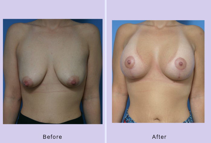 Before and After Image: breast lift – case 16 - front