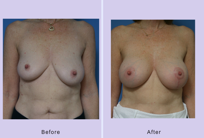 Before and After Image: breast lift – case 17 - front