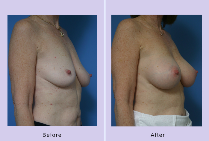 Before and After Image: breast lift – case 17 - right-front-oblique