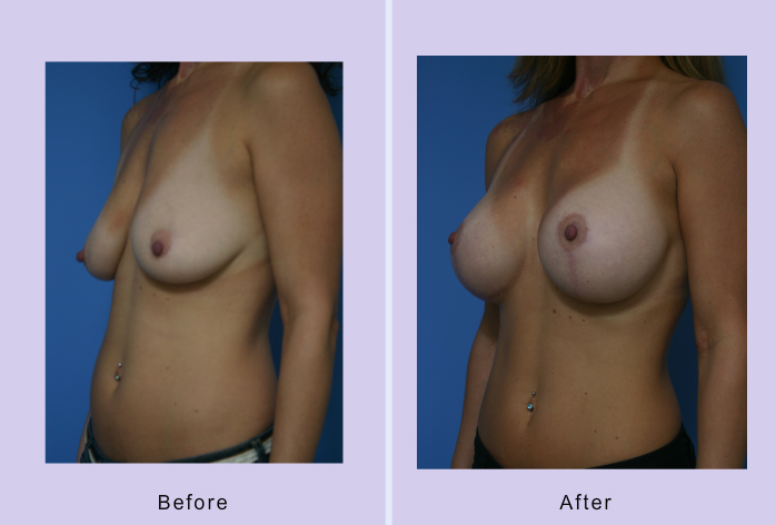 Before and After Image: breast lift – case 18 - left-front-oblique