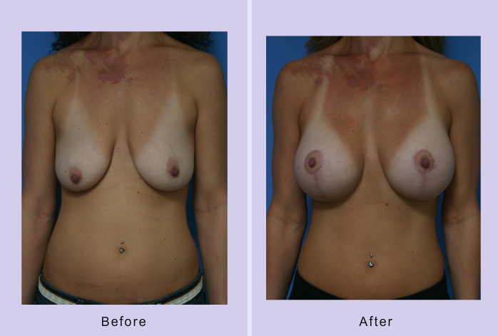 Before and After Image: breast lift – case 18 - front