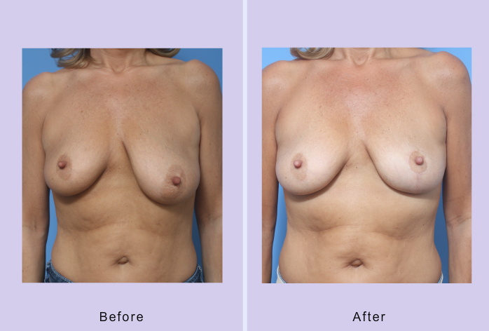 Before and After Image: breast lift – case 19 - front