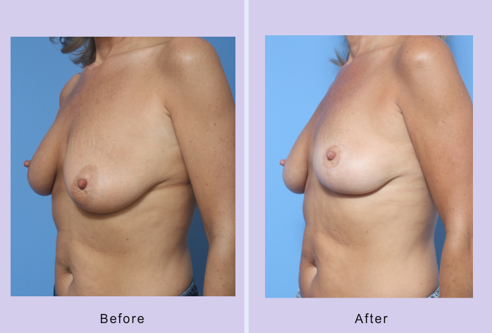 Before and After Image: breast lift – case 19 - left-front-oblique