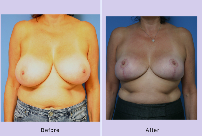 Before and After Image: breast reduction – case 7 - front