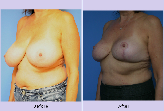 Before and After Image: breast reduction – case 7 - left-front-oblique