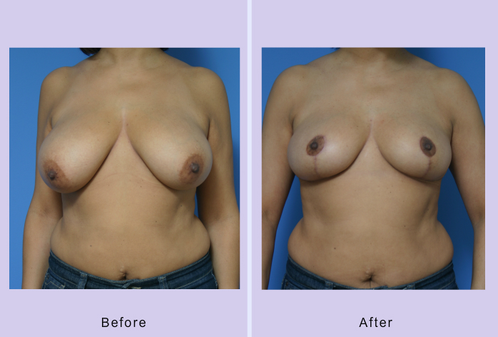 Before and After Image: breast reduction – case 8 - front