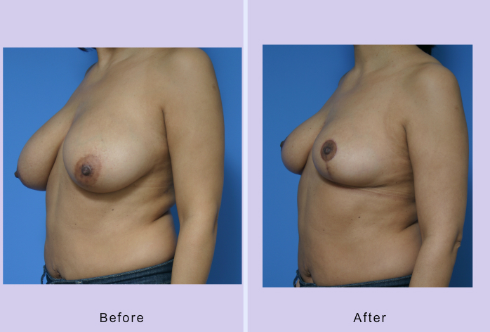 Before and After Image: breast reduction – case 8 - left-front-oblique