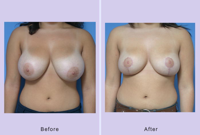 Before and After Image: breast reduction – case 9 - front