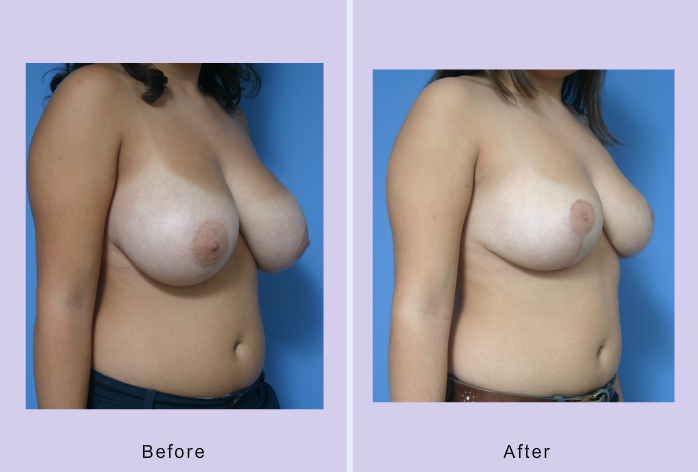 Before and After Image: breast reduction – case 9 - right-front-oblique