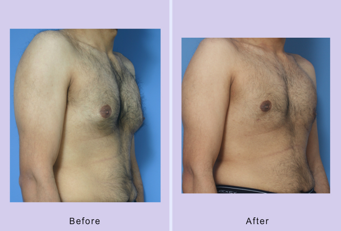 Before and After Image: gynecomastia – case 2 - right-front-oblique