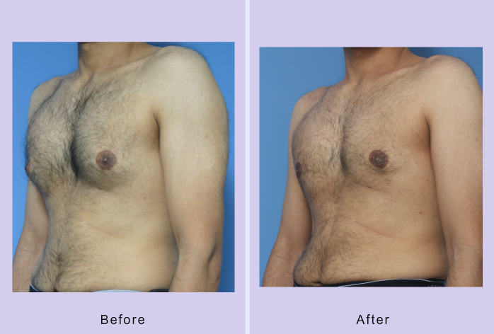 Before and After Image: gynecomastia – case 2 - left-front-oblique